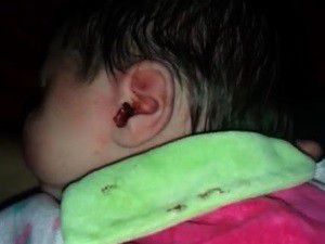 Segundo a mãe, havia mais de 20 larvas vivas no ouvido da recém-nascida