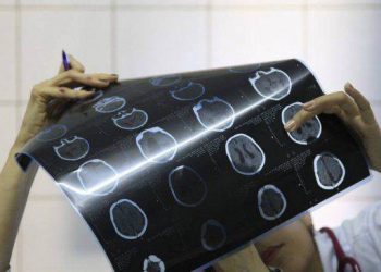 Microcefalia é a condição de bebês que nascem com a cabeça menor do que o tamanho esperado (Foto: Reprodução)