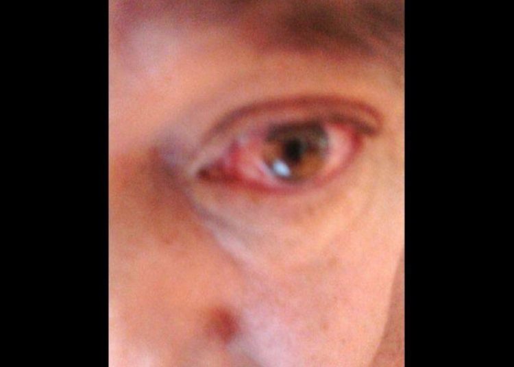 Olho de paciente com zika, dengue e chikungunya (Foto: J. Infect. Public Health/divulgação)