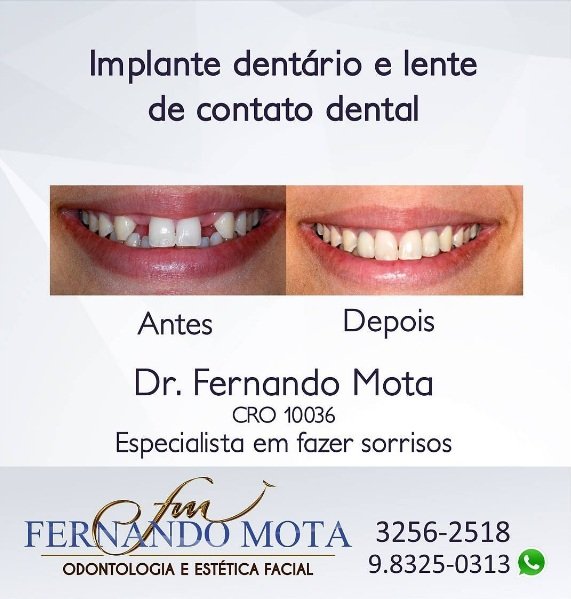 implante-dentario-em-goiania