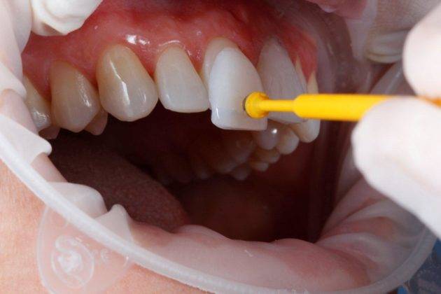 Aplicação da lente de contato dental é um procedimento simples | Foto: Reprodução