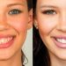 Lente de contato dental é feita sob medida | Foto: Reprodução