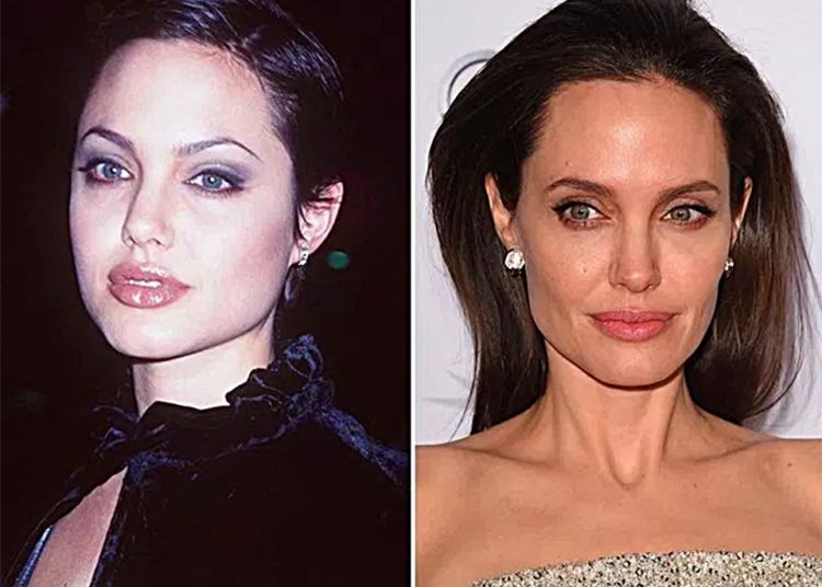 Pretende fazer uma bichectomia em Goiânia? Saiba tudo sobre a cirurgia pela qual a atriz Angelina Jolie já passou | Foto: Reprodução