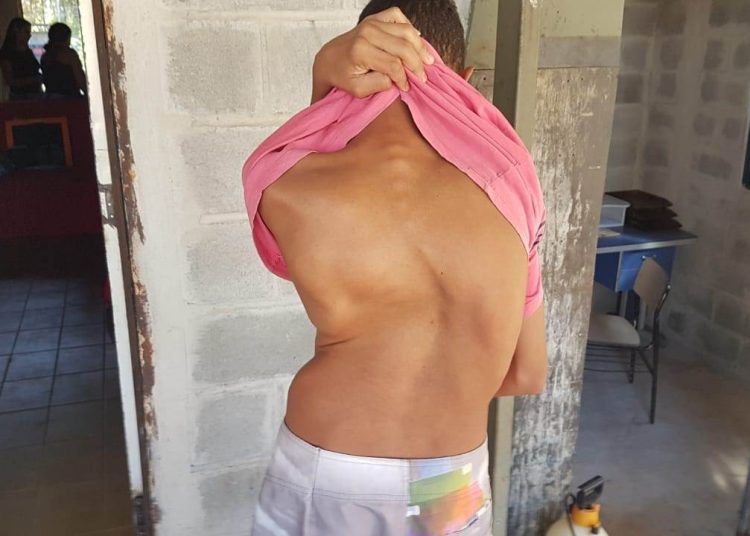 Jovem com escoliose busca cirurgia em Aparecida: 'É ruim viver assim' | Foto: Folha Z