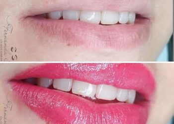 Revitalização labial em Goiânia