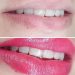 Revitalização labial em Goiânia