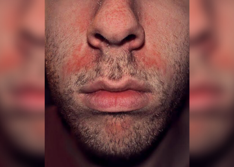 dermatite seborreica