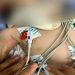 Bebê é intubado com hematomas e pais não sabem explicar como ocorreu | Foto: Divulgação