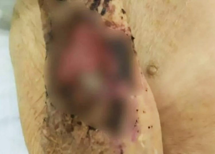 Idoso tinha larvas em feridas pelo corpo | Foto: Reprodução
