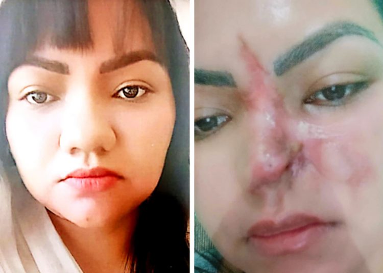 Esteticista Elielma Carvalho procurou a Polícia Civil para denunciar que perdeu parte do nariz após uma cirurgia estética realizada por um dentista em Aparecida de Goiânia | Foto: Reprodução