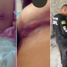 Esteticista que deixou pacientes com rostos, peitos e nádegas deformados é investigada em Aparecida