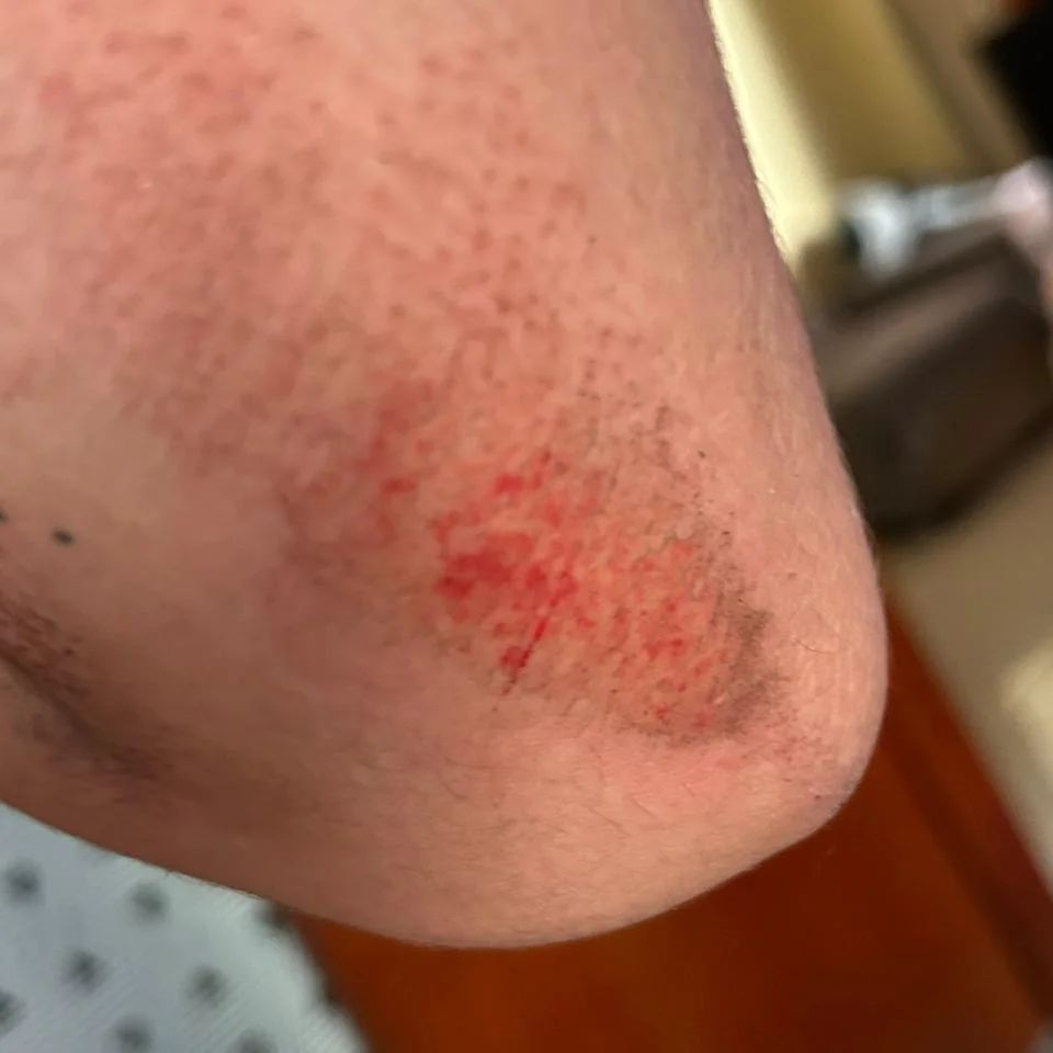 Vítima sofreu escoriações pelo corpo | Foto: Divulgação
